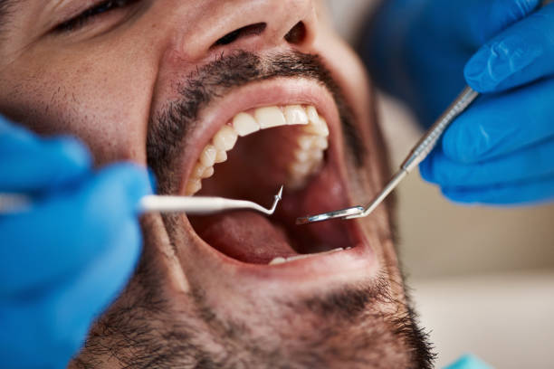 Best Emergency Tooth Extraction in Woodbridge, CA